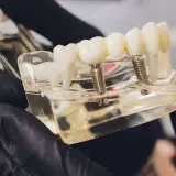 Modello di protesi dentale che illustra l'impianto dentale all on four, con viti che simulano gli impianti.