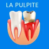 Dente sano e dente cariato con gengive infiammate. Illustrazione sulla pulpite, suggerendo la necessità di rimedi per il nervo dente infiammato.