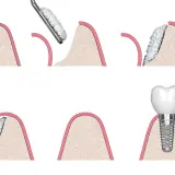 Illustrazione delle fasi di un innesto osseo dentale: preparazione, aggiunta di materiale osseo e inserimento dell'impianto.