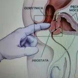 Anatomical illustration showing a gloved finger performing a prostate massage through the rectum.