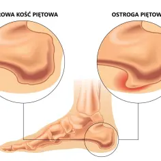 Ilustracja porównuje zdrową kość piętową z tą dotkniętą ostrogą. Babcine sposoby na ostrogi piętowe mogą pomóc złagodzić ból.