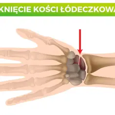 Złamana kość łódeczkowata nadgarstka, zaznaczona czerwoną strzałką, pokazuje pęknięcie w tej małej kości.