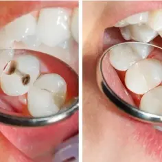 Jak wyleczyć próchnicę bez dentysty? Skuteczne metody i porady