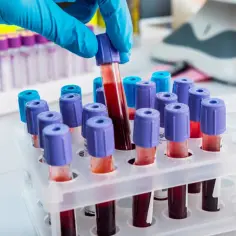 Ręka w niebieskiej rękawiczce pobiera probówkę z krwią. Badania krwi mogą pomóc zdiagnozować problemy z pamięcią.