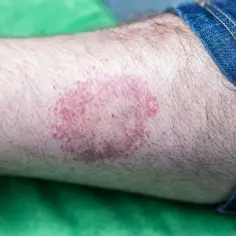 Rumień po kleszczu, widoczny na nodze, rozszerza się. Czerwona plama z ciemniejszymi obrzeżami.