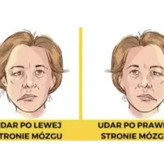 Dwie twarze z widocznym porażeniem nerwu twarzowego. Lewa strona twarzy opada po udarze mózgu po lewej stronie, prawa po udarze po prawej.