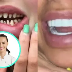Przed i po metamorfozie uśmiechu. Zęby w Turcji to marzenie o idealnym uśmiechu.
