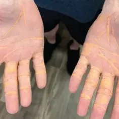 Dłonie z żółtymi zmianami skórnymi, mogącymi świadczyć o wysokim cholesterolu.