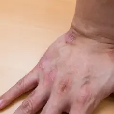 Skóra na dłoni jest zaczerwieniona i łuszcząca się. To może być objaw problemów zdrowotnych, takich jak anemia, która wpływa na ogólne samopoczucie.