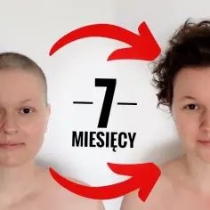 Jak szybko odrastają włosy po chemii? Poznaj kluczowe czynniki