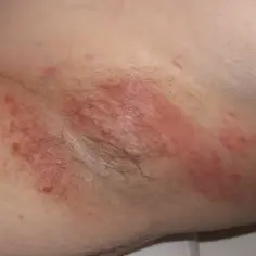 Skóra pod pachami zaczerwieniona, z widocznymi zmianami, wskazującymi na odparzenia.