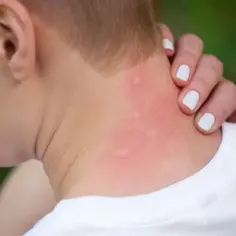 Alergia na pyłki objawy skórne: jak je rozpoznać i leczyć