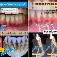 Przed i po: recesja dziąseł i zanik kości. Zdjęcia pokazują postęp paradontozy i jej skutki, ale też możliwość odbudowy kości.