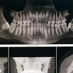 Dentyści analizują prześwietlenie szczęki, wskazując na problem z zębami.