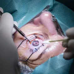 Chirurg podczas zabiegu laserowej korekcji wzroku. Od ilu lat można poddać się tej procedurze?