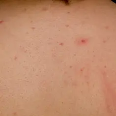 Co oznaczają pryszcze w poszczególnych miejscach i jak je leczyć?