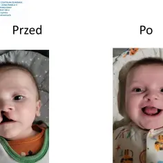 Uśmiechnięty chłopiec po korekcie rozszczepu podniebienia. Zdjęcie pokazuje przemianę dziecka przed i po zabiegu.