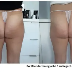 Porównanie ud przed i po zabiegach: widoczna redukcja cellulitu.