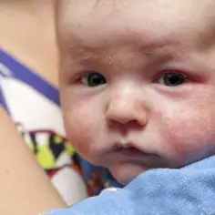 Jak wygląda alergia u niemowlaka? Objawy, które musisz znać