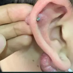 Widoczne jest zaczerwienienie i obrzęk wokół kolczyka w uchu, sugerujące **keloid piercing**. Widoczny jest też duży, guzowaty przyrost tkanki na płatku ucha.