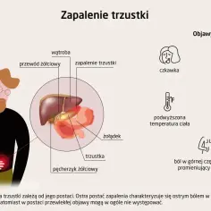 Ilustracja przedstawia objawy zapalenia trzustki, w tym ból brzucha, nudności i gorączkę. Przewlekłe zapalenie trzustki może mieć subtelne symptomy.