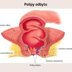 Anatomia odbytu z zaznaczonymi polipami. Czy polip to nowotwór? Ilustracja pokazuje mięsień dźwigacz odbytu, zwieracze i gruczoły odbytu.