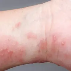 Skuteczne leki na świerzb, które pomogą Ci pozbyć się problemu
