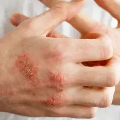 Alergia na gluten objawy skórne – jak je rozpoznać i leczyć