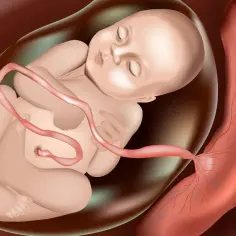 Płód w worku owodniowym, z pępowiną połączoną z łożyskiem. Ilustracja pokazuje bezobjawowe odklejenie łożyska.