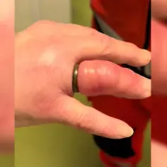 Jak zdjąć obrączkę nitką i uniknąć bólu przy spuchniętym palcu