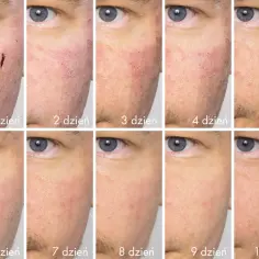Post-zabiegowa regeneracja skóry po laserze frakcyjnym. Widoczna poprawa od 1 do 10 dnia.