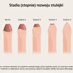 Ilustracja pokazuje stadia rozwoju stulejki, czyli zwężenia napletka. Od normy do stadium 4, gdzie występują trudności z oddawaniem moczu.