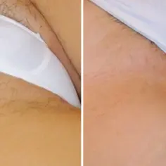Ile zabiegów laserem na bikini potrzebujesz, by osiągnąć efekt?