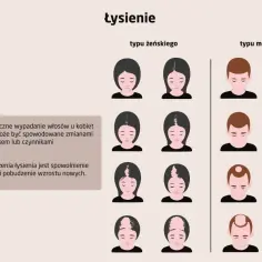 Wyleczyłam łysienie plackowate, widząc na obrazku różne etapy łysienia u kobiet i mężczyzn.