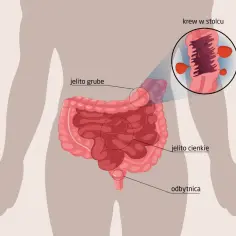 Ilustracja jelita grubego z powiększeniem pokazującym krew utajoną w kale.