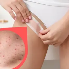 Jak pozbyć się krostek po goleniu bikini i cieszyć się gładką skórą