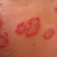 Suche czerwone plamy na ciele, nie swędzące, przypominające łuskę.