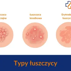 Ilustracja pokazuje trzy typy łuszczycy: zwyczajną, krostkową i erytrodermię łuszczycową. Początki łuszczycy mogą objawiać się różnie.