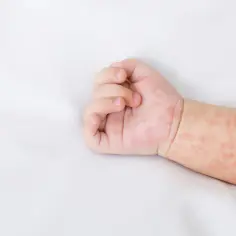 Ręka niemowlaka z zaczerwienionymi plamkami, objawami egzemy.
