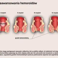 Ilustracja przedstawia cztery stopnie zaawansowania hemoroidów, ukazując zmiany w odbytnicy. Różne hemoroidy objawy to ból, pieczenie, krwawienie.