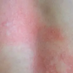 Czerwona, swędząca wysypka na skórze, która może być oznaką reakcji alergicznej lub jak wygląda obrzęk po kleszczu.