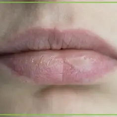 Zadbaj o swoje suche usta. Zobacz, co na nie pomoże i przywróci im komfort i nawilżenie.