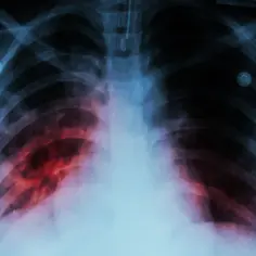 RTG klatki piersiowej z widocznym włóknieniem płuc. Jak zatrzymać włóknienie płuc? Wczesna diagnoza jest kluczowa.