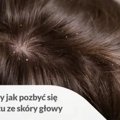 Zbliżenie na ciemne włosy z widocznym łupieżem na skórze głowy.