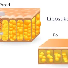 Przed i po zabiegu liposukcji kawitacyjnej: ilustracja pokazuje redukcję komórek tłuszczowych.