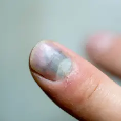 Zasiniony paznokieć po urazie. Widoczne ciemne przebarwienia i pęknięcie.