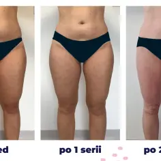 Kriolipoliza efekty po 1 zabiegu: porównanie sylwetki przed i po serii zabiegów. Widoczna redukcja tkanki tłuszczowej na udach i brzuchu.