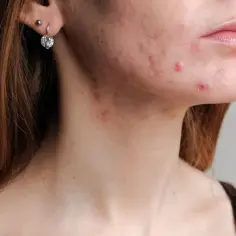 Skóra z niedoskonałościami, widoczne zaczerwienienia i wypryski na policzku i szyi. Może to być problem, z którym pomoże **Normaclin**.