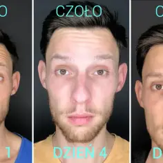 Botoks kiedy efekt - jak szybko zobaczysz rezultaty i co warto wiedzieć