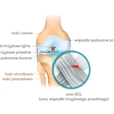 Anatomia kolana z zaznaczonym urazem ACL (przedniego więzadła krzyżowego). Widoczne pęknięcie więzadła.